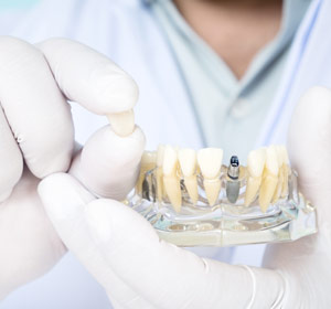 Orthodontic Tooth Implant